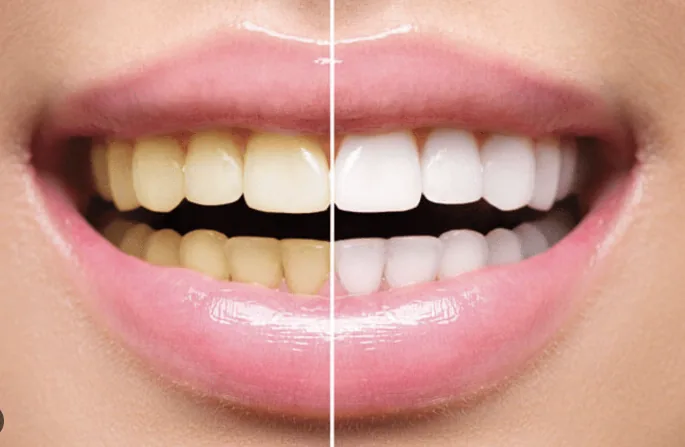 Quais os benefícios de fazer Clareamento Dental?