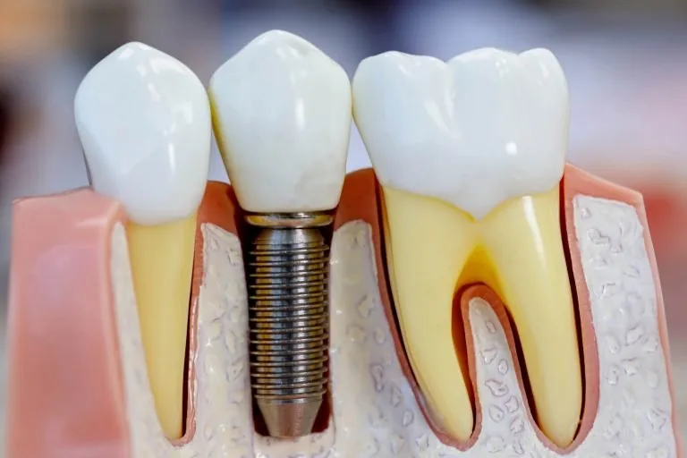 O que é um Implante Dentário?
